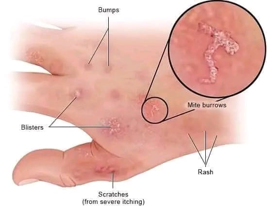 Scabies: Causes, Symptoms, Treatment & Prevention | স্ক্যাবিস: কারণ, লক্ষণ, চিকিৎসা ও প্রতিরোধ